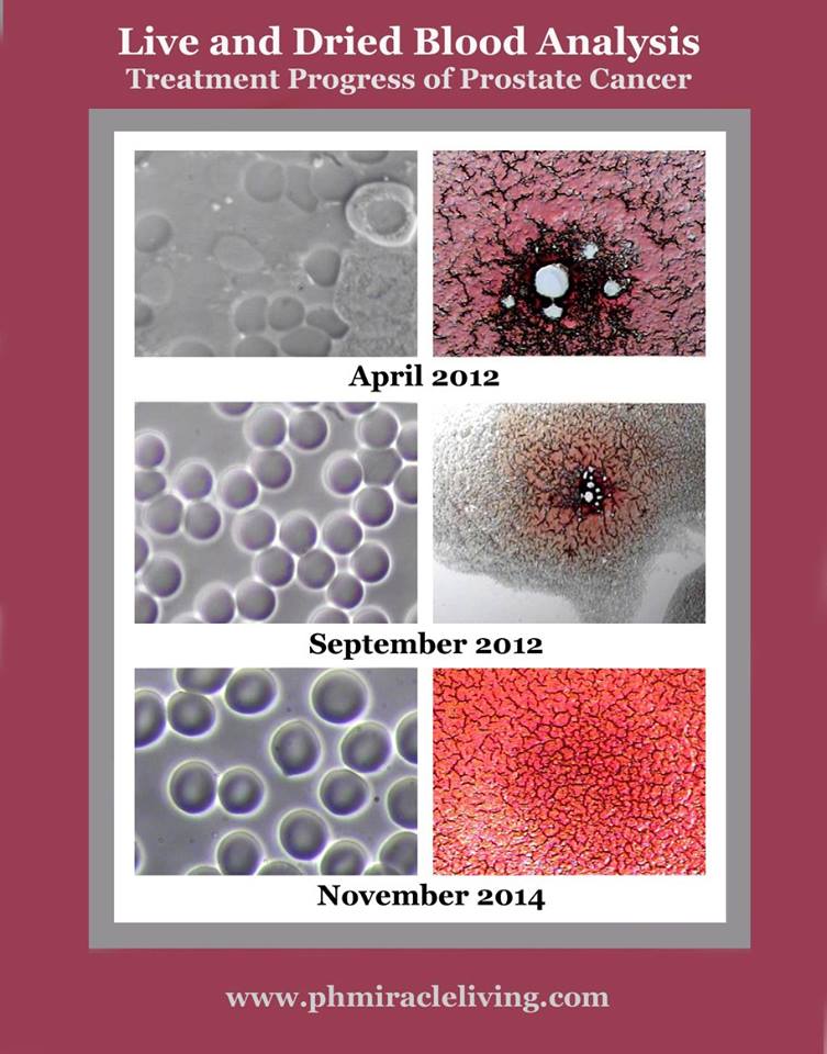 analiza krwi rak prostaty przed i po