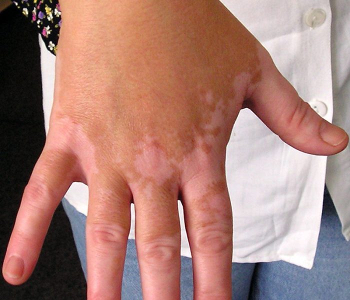Zbawienny wpływ cudu równowagi pH na problem bielactwa skóry